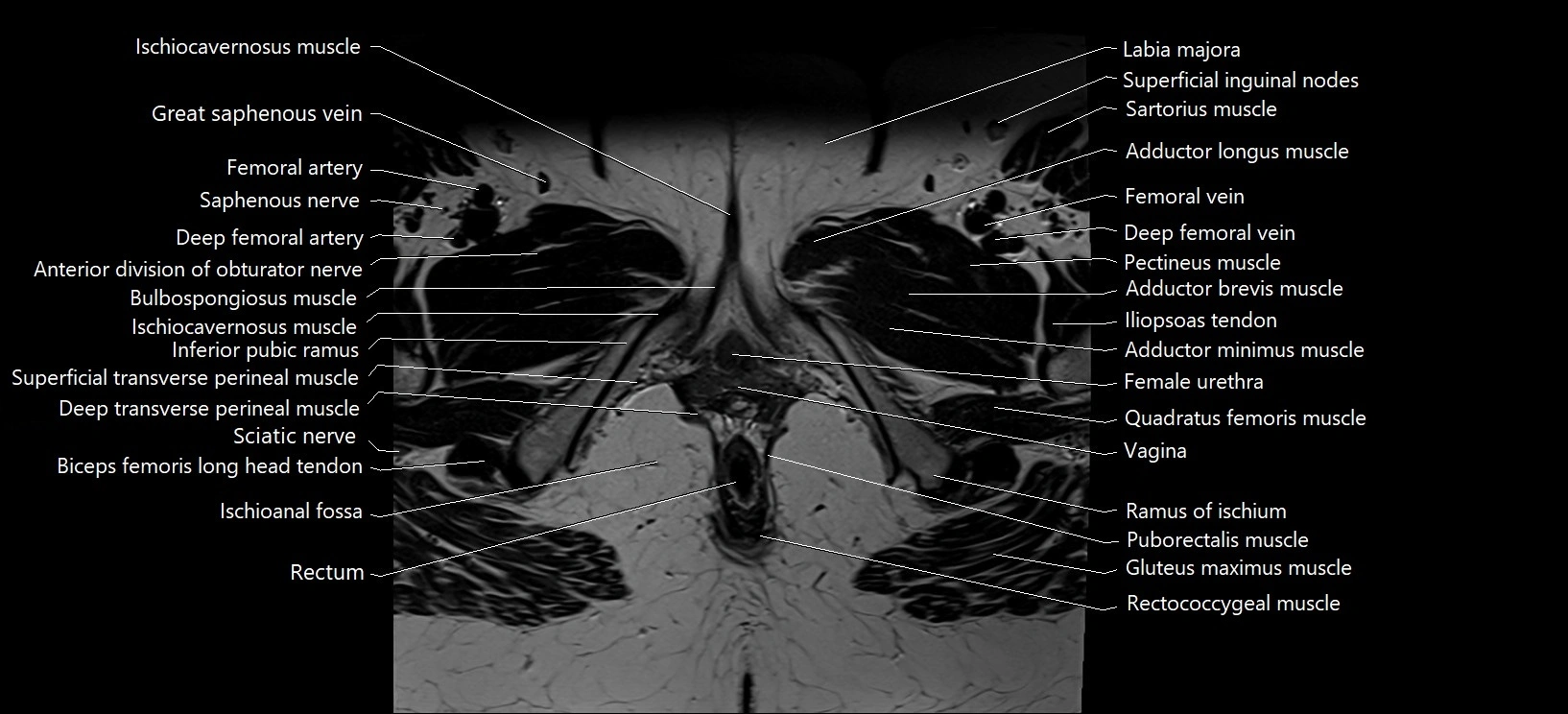 Axial cross sectional anatomy of female pelvis (MRI 3T) image 42.webp